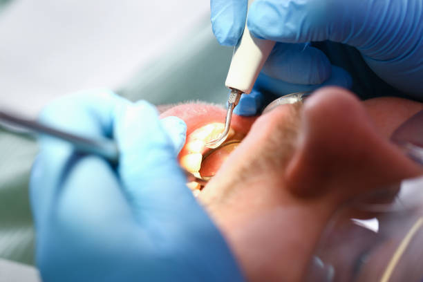 Best Emergency Root Canal Treatment in Lewiston, MN