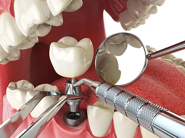 Best Emergency Tooth Extraction in Lewiston, MN